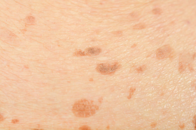 Aromatherapy for Age Spots